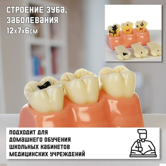 Макет &quot;Строение зуба, заболевания&quot;, 12*7*6см